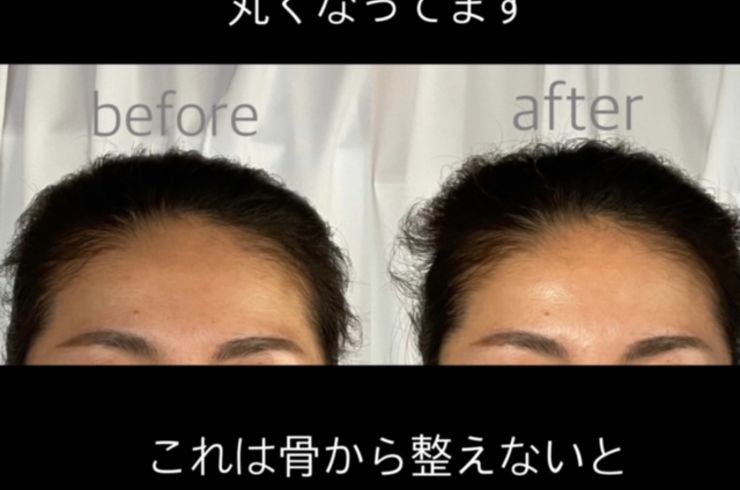 女性の額　ビフォーアフター